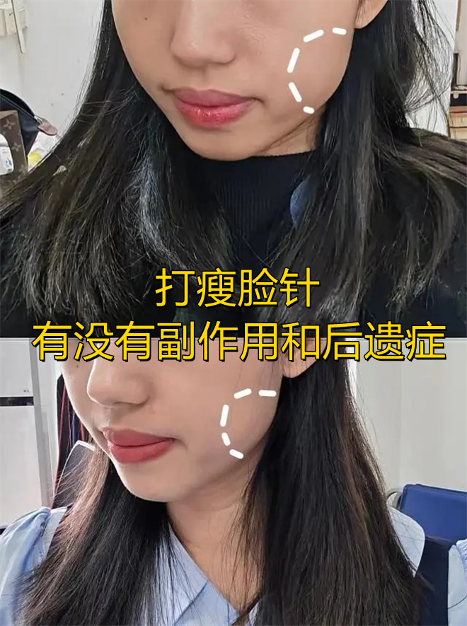 乐普医疗：注射用重组A型肉毒毒素临床试验申请获批