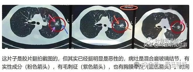 “十年体检未检出癌症”引发信任危机，爱康集团否认“假体检”，与客户互诉公堂罗生门愈演愈烈