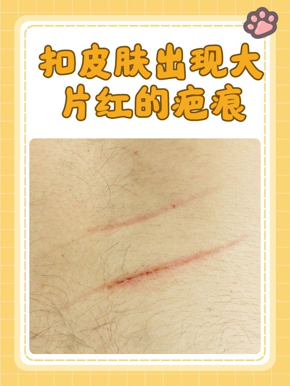 科兴制药：GB19注射液皮肤型红斑狼疮适应症药物临床试验申请获批